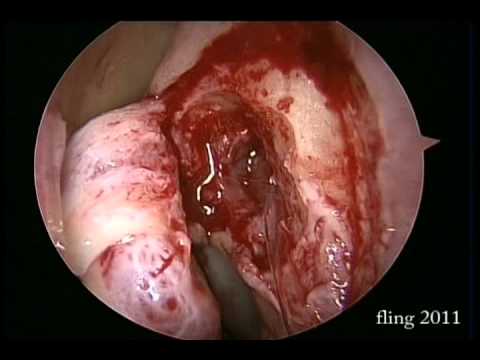 Left Dacryocystorhinostomy - Endoscopy