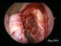 Left Dacryocystorhinostomy - Endoscopy Left Dacryocystorhinostomy - Endoscopy
