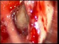BRAIN TUMOR-colloid cyst 3rd ventrical microsurgical excission-dr suresh dugani/HUBLI/INDIA