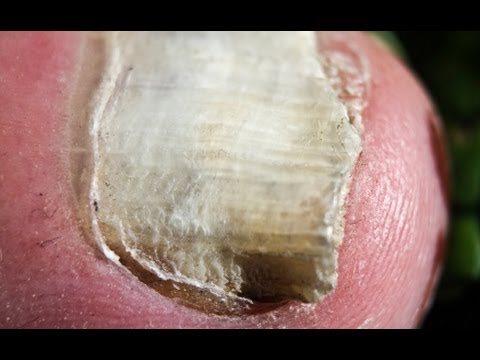 how to whiten fungal nails