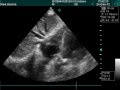 Double Left Supra Hepatic Vein View In Doppler Examination Double Left Supra Hepatic Vein View In Doppler Examination
