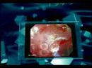 video-colonoscopy-displaying-a-colon-cancer.html