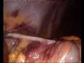 SCABINI: EMICOLECTOMIA DX E SX VIDEOLAPAROSCOPICA PER CANCRO