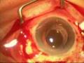 Vitrectomy and removal of posteriorly dislocated IOL