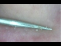 Comedones popped