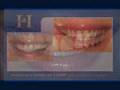 Meghan's Waterlase Dental Treatment LaserDentistry.com