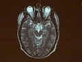 Normal Transverse MRI 3