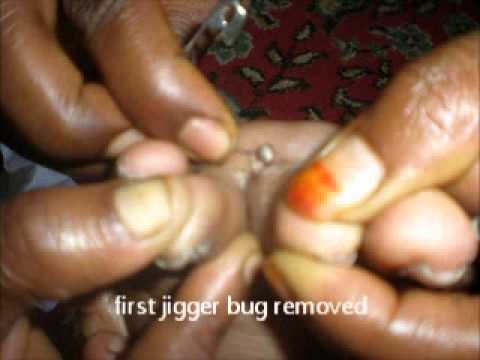 how to remove jiggers