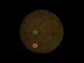Opthalmoscopic Examination