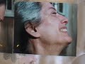 Lies -Tragedy of Botched Cosmetic Surgery- Dr. Eppley
