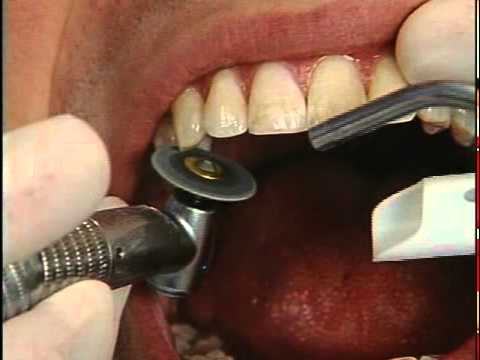 Gordon shows how you can remove tooth stains using muriatic acid