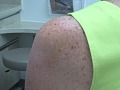 How to give a Subacromial Injection