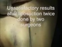 Prof. F. Alkhairy Cosmetic Surgery Centre Alkhairys Hospital Karachi Gynecomastia ( teaching ) Prof. F. Alkhairy Cosmetic Surgery Centre Alkhairys Hospital Karachi Gynecomastia ( teaching )