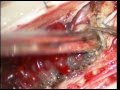 spinal cord arterio-venous malformation AVM -microsurgery-drsureshdugani/HUBLI/INDIA