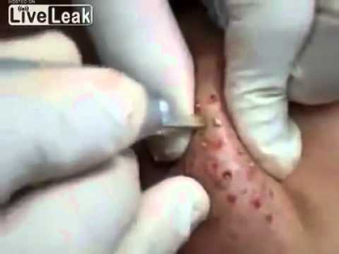 how to treat oozing pimple