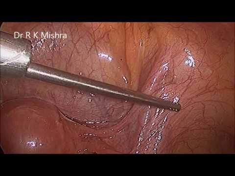 Dr R K Mishra Demonstrating Pelvic Anatomy, Triangle of Doom Ureter and Iliac Vessel