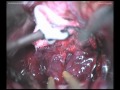 Medulloblastoma - Median suboccipital approach