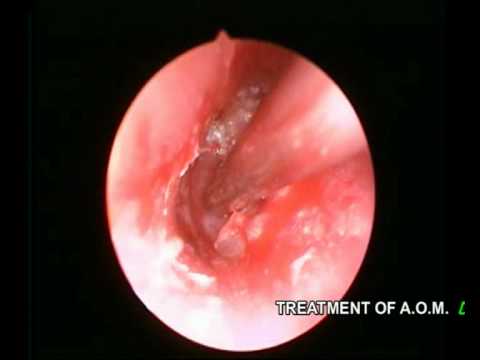 how to treat otitis media in adults