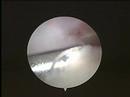 Arthroscopic Ankle Surgery - Jason Pietrzyk