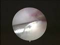 Arthroscopic Ankle Surgery - Jason Pietrzyk