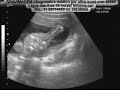 GRAVIMAGEM 878 (ULTRA-SOM DE GRAVIDEZ COM 21 SEMANAS)