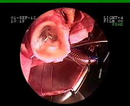 Clinical smart canula® application ...