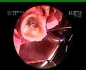 Clinical smart canulaŽ application for Ross procedure Clinical smart canulaŽ application for Ross procedure