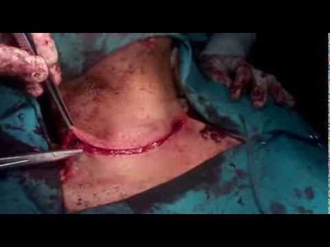 how to cure euthyroid