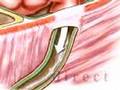 PreOp-Patient-Educat