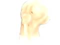 videos de Malpractice Medical Arthroscopic Meniscus Repair of Knee Surgery 3