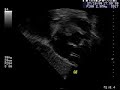 Atrial embolization (gsv thrombus fragmentation)