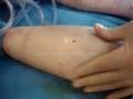 Click to View : Liposuction by Dr. Abel Mounir