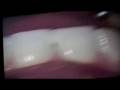 videos de dianna first exam before veneers