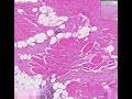 Histopathology Abdomen--Desmoid tumor