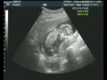 Candice's 14 Week Ultrasound