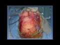 Modified 1-Pc Extended Transbasal Approach. Giant Anterior Skull Base Sinonasal Teratocarcinosarcoma