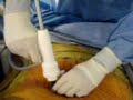 Visiport insufflation in gastric banding Visiport insufflation in gastric banding