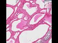 Histopathology Neck--Lymphangioma (cystic hygroma) Histopathology Neck--Lymphangioma (cystic hygroma)