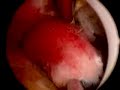 Hysteroscopy - endometrial polyp Hysteroscopy - endometrial polyp