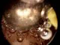 Hysteroscopy - endometrial polyp