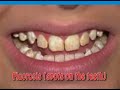 Fluoridation of Water - the balanced perspective Fluoridation of Water - the balanced perspective