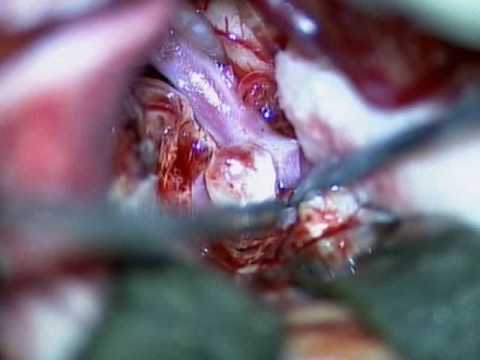 If an aneurysm presents with aneurysm clips. If an aneurysm presents with