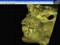 Procedura ray set Implant 3d (Ver. 3.0)