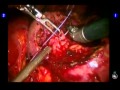 Partial Nephrectomy In Robot Assistance