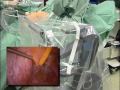 Laparoscopy: Promonto fixation