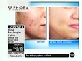 Murad Acne Complex 4-piece Starter Kit - Item: 235-581