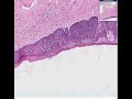 histopathology vulva--severe dysplasia