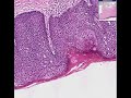 histopathology vulva--severe dysplasia
