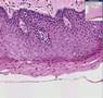 Histopathology Vulva--Severe dysplasia