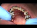 Removing a TPA